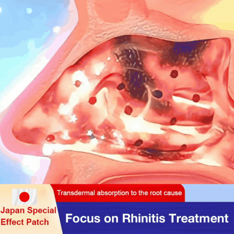 Acupuncture Point Rhinitis Relief Patches